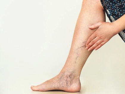 A woman holding her lower leg, with veins visible on the calf
